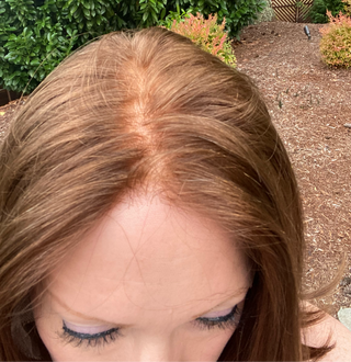 Bleached knots close up hairline 